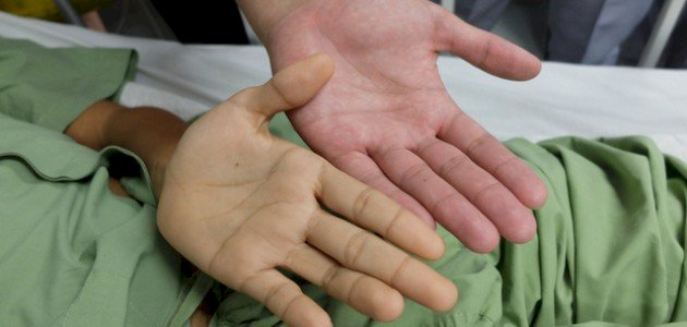 اصفرار اليدين والقدمين عند الأطفال