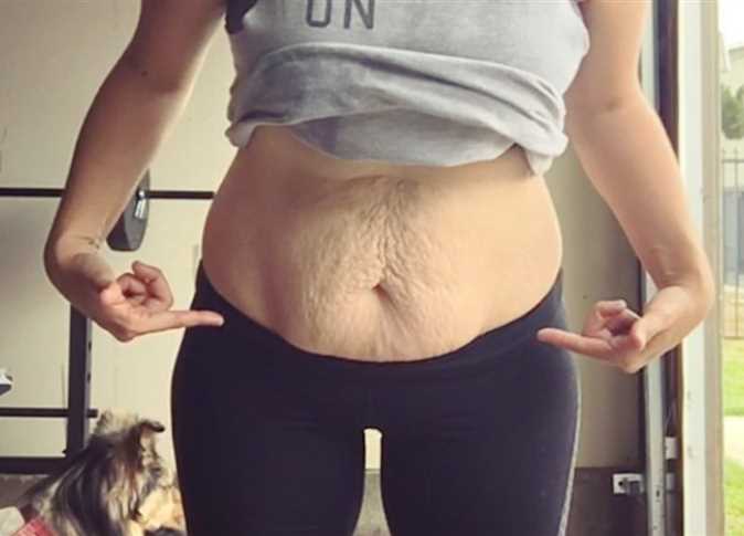 أنواع ترهلات البطن