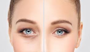 عمليات تجميل العين المصابة