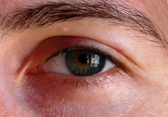 كدمات العين بعد عملية تجميل الأنف