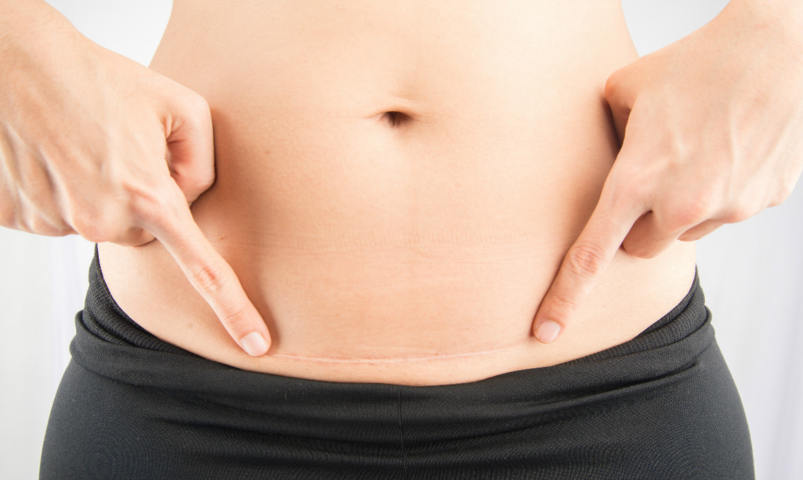 الخياطة التجميلية بعد الولادة بالصور